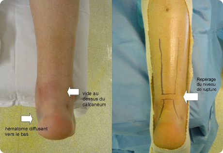 Tendon d achille Centre Orthop dique Pasteur Lanroze